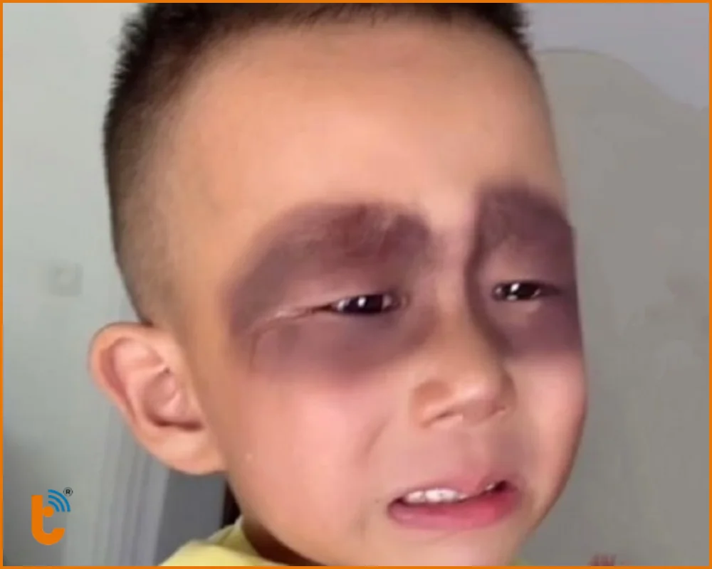 Hình ảnh em bé bị thâm mắt như gấu trúc